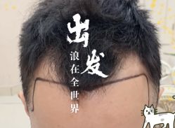 -大麦微针植发全国连锁