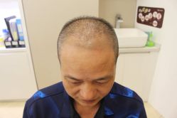 -大麦微针植发丨全国连锁