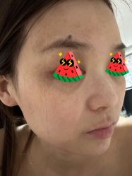 体验前-More摩尔医美の注射线雕光电中心