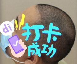 -大麦微针植发全国连锁