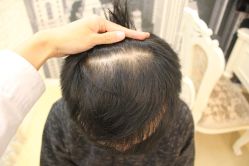 点击看大图 -大麦微针植发丨全国连锁