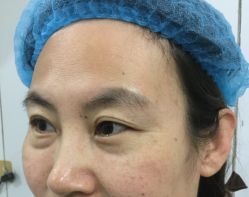 -天津健丽·去眼袋医疗美容机构