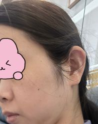 体验前-苏州卫康美容医院