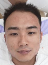-痘博士广州·全国连锁祛痘机构