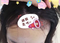 -大麦微针植发全国连锁