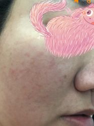 体验前-北京英煌医疗美容