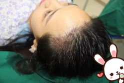 -大麦微针植发丨全国连锁