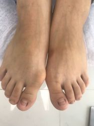 点击看大图 -派恩宜灰指甲鸡眼嵌甲手足癣