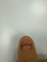 android_upload_pic-EPAI·灰指甲·甲沟炎·嵌甲护理