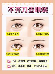 -广州健丽·去眼袋医疗美容机构