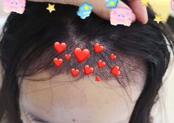 -大麦微针植发全国连锁