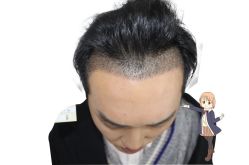 -大麦微针植发丨全国连锁