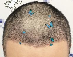 -大麦微针植发全国连锁