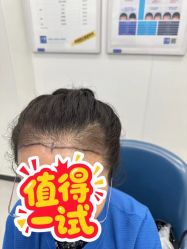 -大麦微针植发全国连锁
