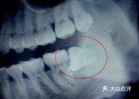 智齿长出来会挤歪其他牙齿吗？