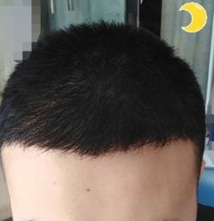 -大麦微针植发丨全国连锁