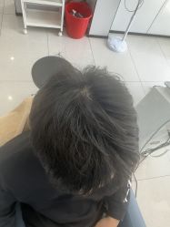 -大麦微针植发丨全国连锁