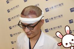 点击看大图 -大麦微针植发丨全国连锁