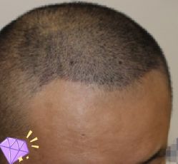 -大麦微针植发丨全国连锁