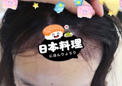 -大麦微针植发全国连锁