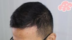 -大麦微针植发丨全国连锁