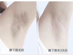 -HEYAN荷妍专业脱毛连锁机构