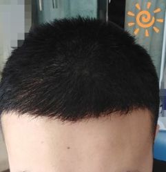 -大麦微针植发丨全国连锁