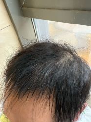 -碧莲盛·不剃发植发