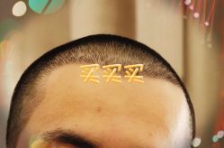 -大麦微针植发全国连锁
