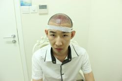 点击看大图 -大麦微针植发丨全国连锁