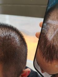 -碧莲盛·不剃发植发