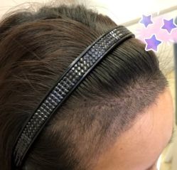 -大麦微针植发丨全国连锁