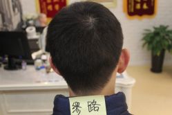 点击看大图 -大麦微针植发丨全国连锁