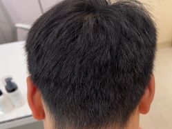 -碧莲盛·不剃发植发