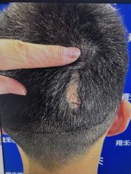 体验前-雍禾植发全国连锁