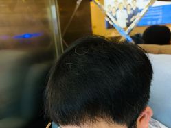 -碧莲盛·不剃发植发