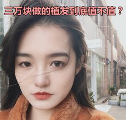 -碧莲盛·不剃发植发