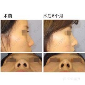 日本整形|关于隆鼻的那些事