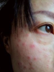点击看大图 体验后-叶美人医疗美容