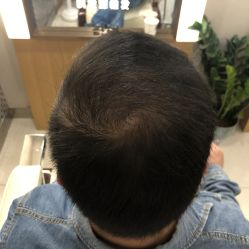 -大麦微针植发全国连锁