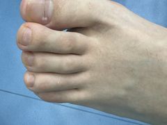 -Andrew指甲专科灰指甲·甲沟炎矫正·3D步态矫形鞋垫定制(浦三路店)