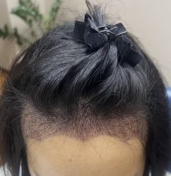 -大麦微针植发全国连锁