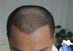 -大麦微针植发丨全国连锁