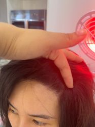 -大麦微针植发全国连锁