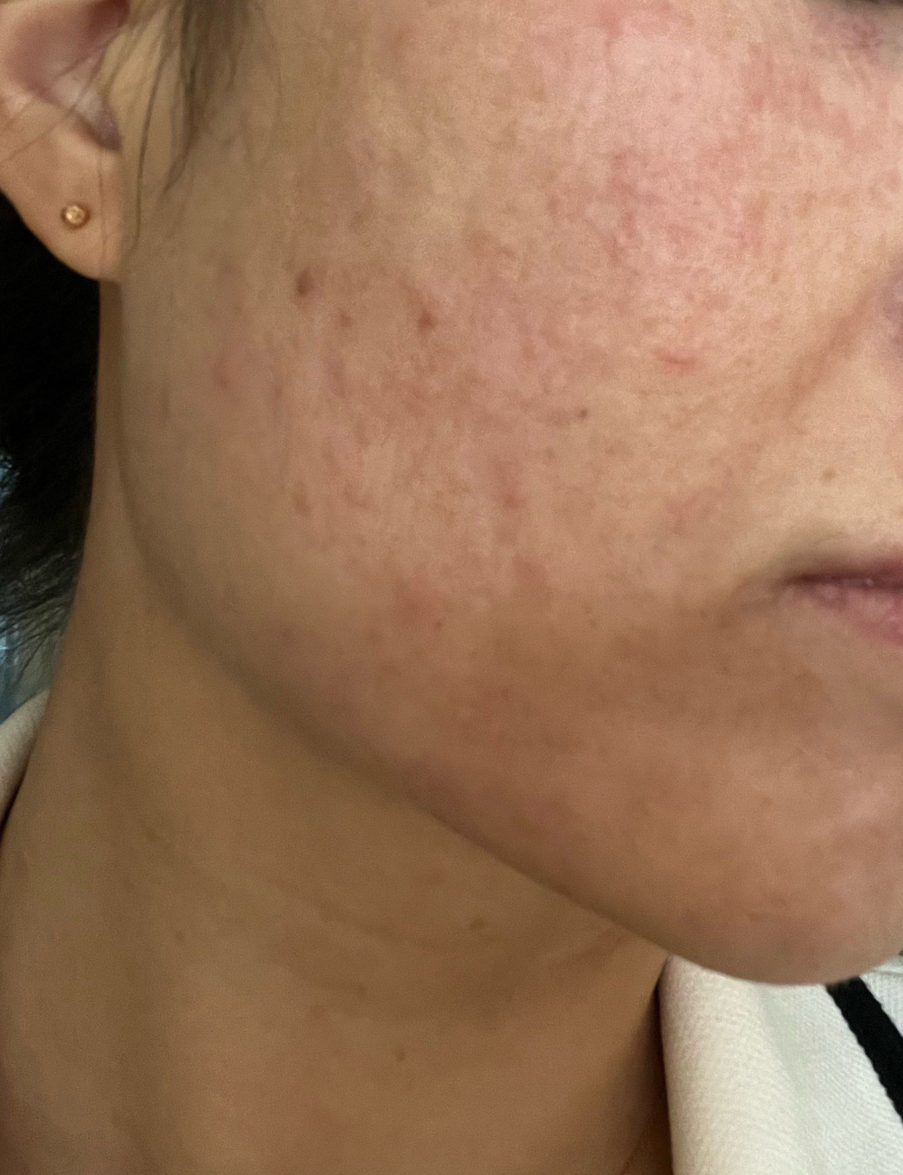 脸过敏了,起了很多小疹子,去这里治疗了一下,好多了,总算不痒了#护肤