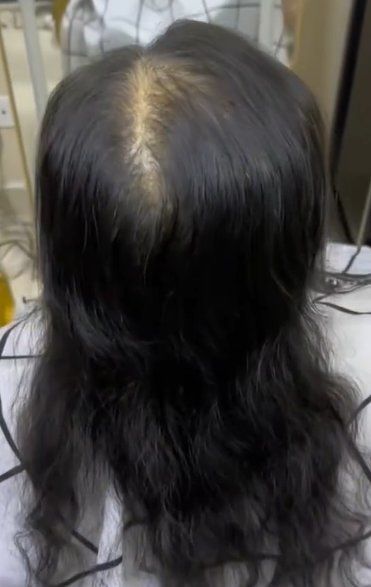 发缝宽头顶头发稀疏的姐妹