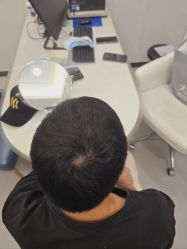 -大麦微针植发全国连锁