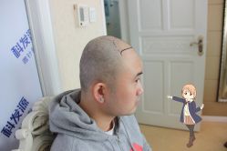 -大麦微针植发丨全国连锁