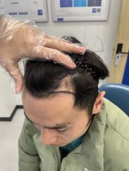 -大麦微针植发全国连锁