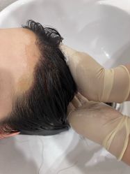 -大麦微针植发全国连锁